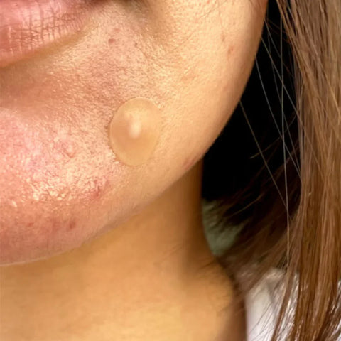 Peace Out Jumbo Acne Dots, 40 Dots, image 2